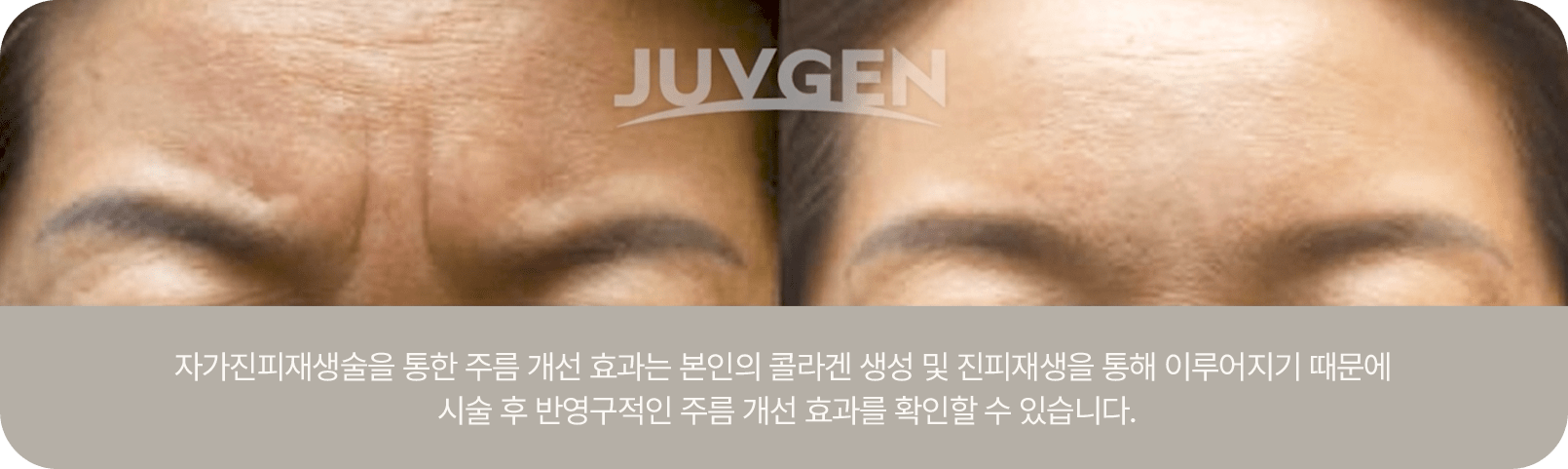 Juvegen施术前后眉间及额头皱纹对比与自体真皮再生术说明文字