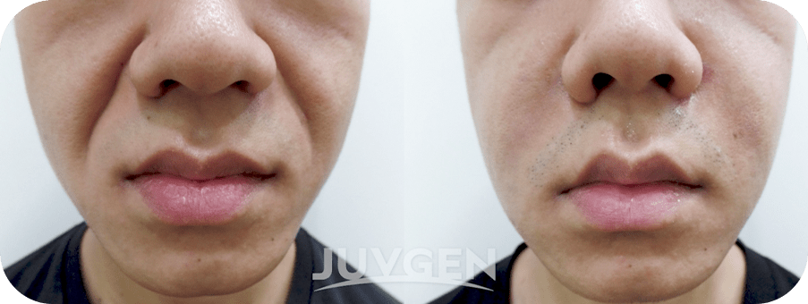 Juvegen施术前后男性法令纹部位对比