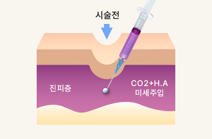 施術前の段階で真皮層にCO2とヒアルロン酸を微細注入する断面図