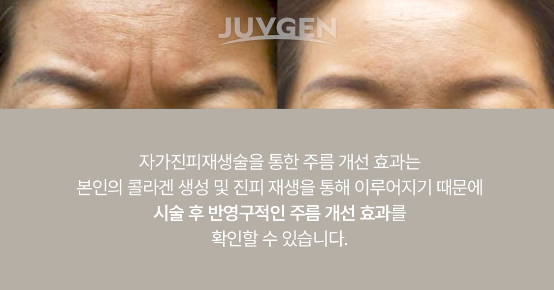 ジュブゼン施術前後の眉間・額のシワ比較と自家真皮再生術の案内文