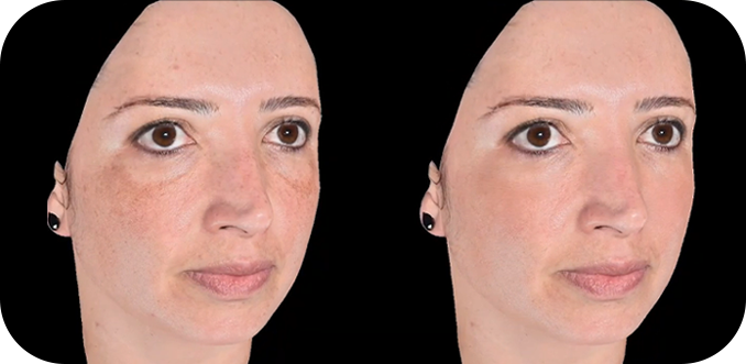 QuantifiCare 3D肌分析の前後の顔の比較