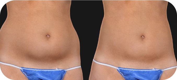 QuantifiCare 3Dボディ分析の前後の腹部の比較