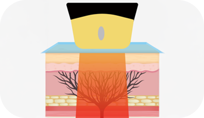 STACK MODEのレーザーエネルギーが皮膚の深い層に集中する様子を描いた断面図